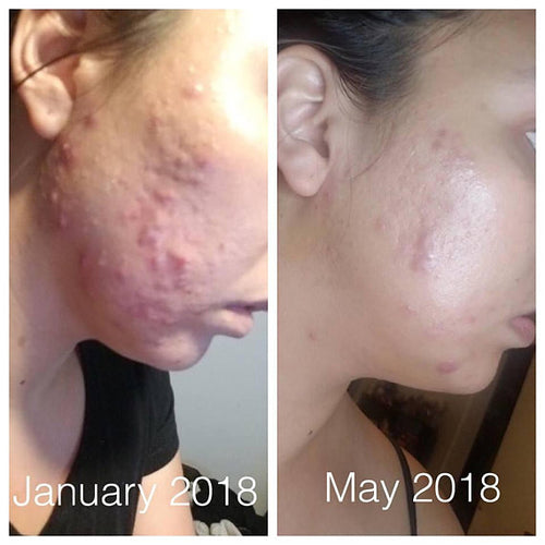 Super Acne Fighter - Organic Acne Treatment Solution