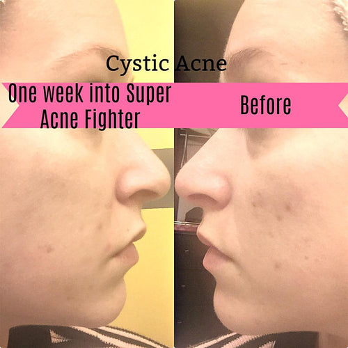 Super Acne Fighter - Organic Acne Treatment Solution